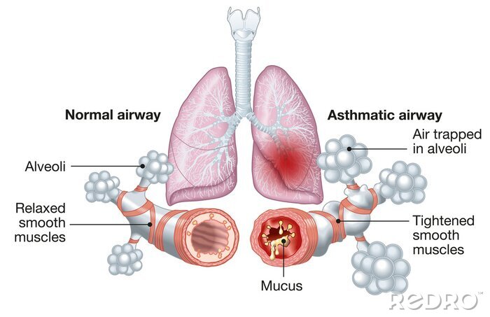 Tableau  Asthma, normal and asthmatic airways, medically illustration